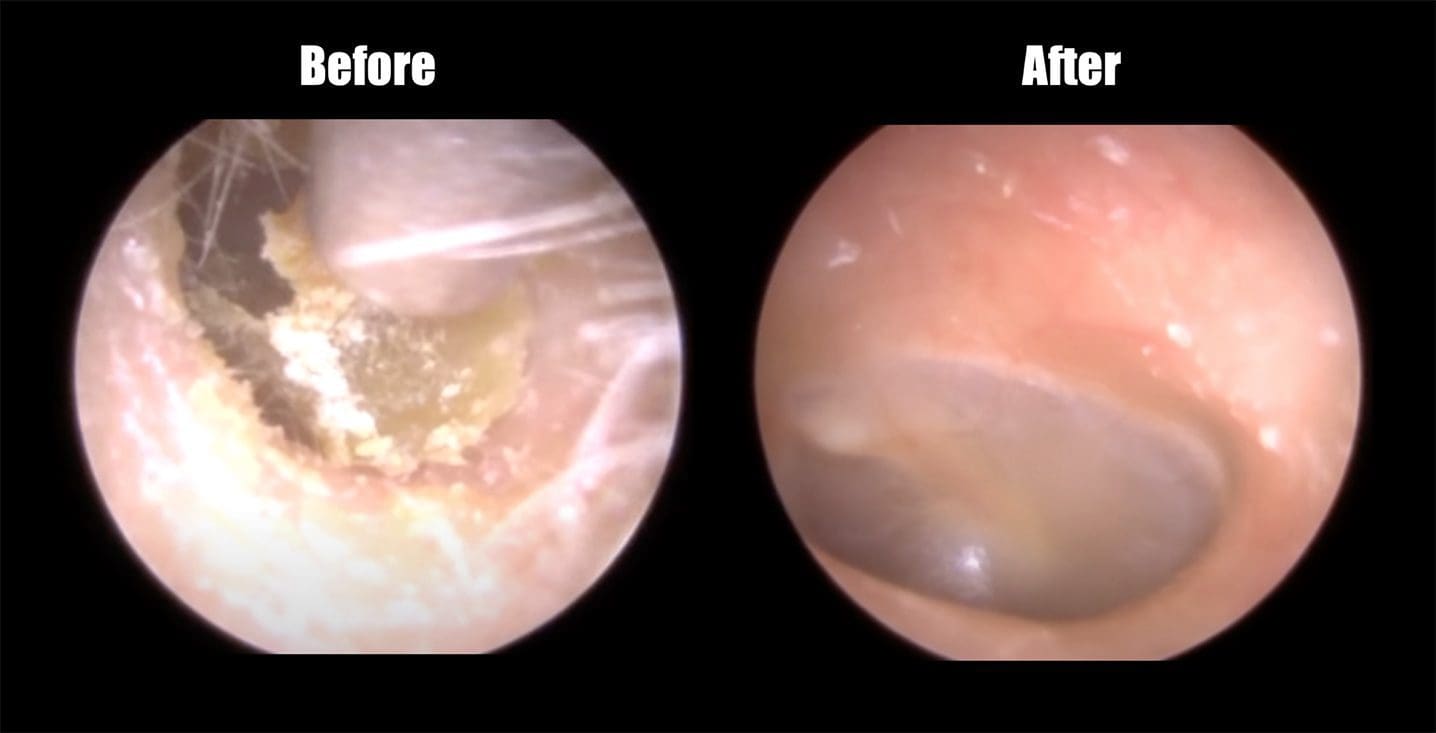 Before and after earwax removal and ear cleaning at Duncan Hearing Healthcare inside the ear image